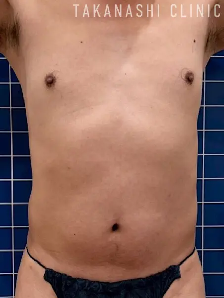 施術後（腹部・7回）