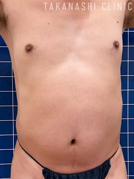 施術前（腹部）